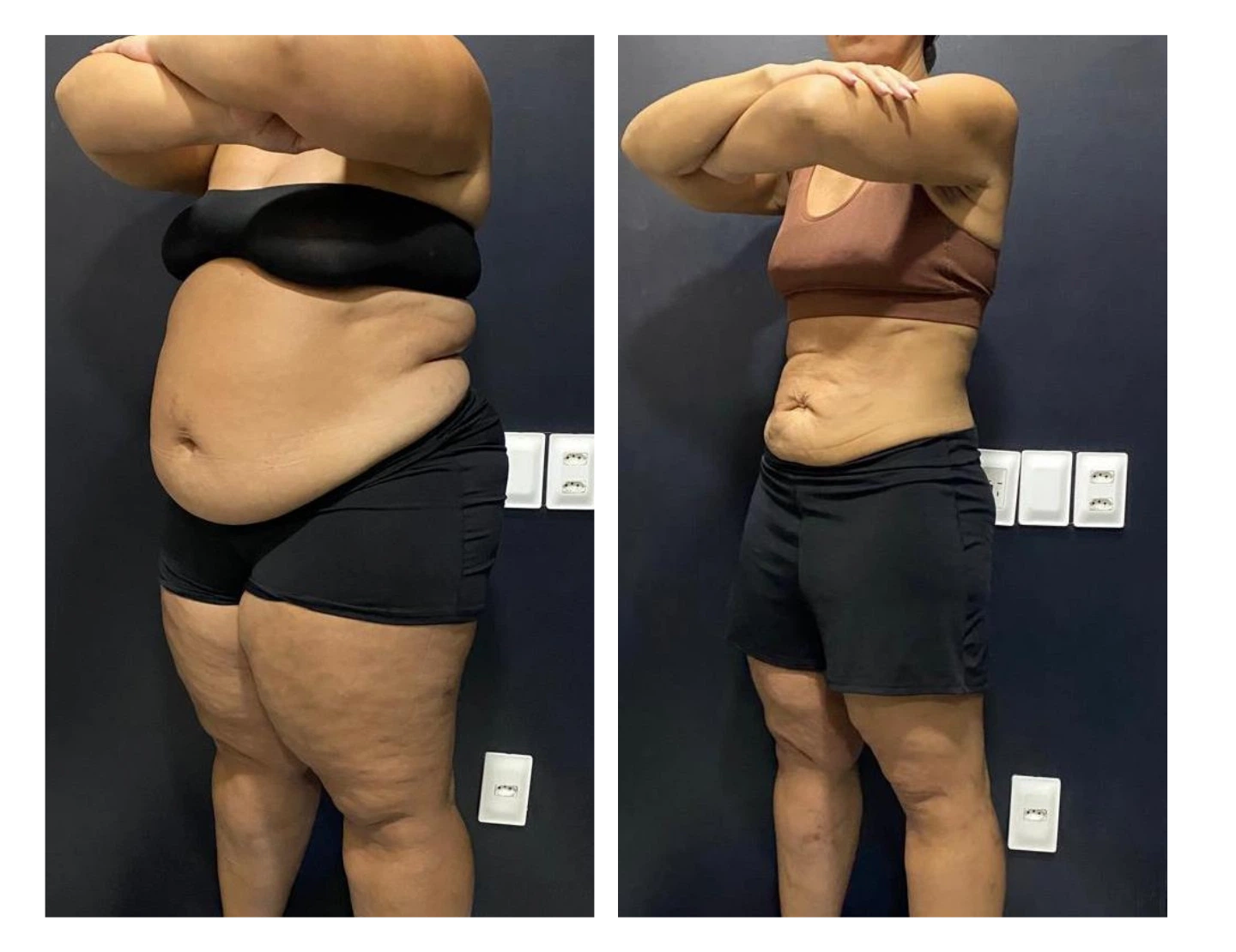 kaliny-suzany-antes-e-depois-8-dr-diego-pascaretta-medico-nutrologo-especialista-em-saude-metaabolica-reposicao-hormonal-e-protocolos-personaizados-de-alta-performance-.webp